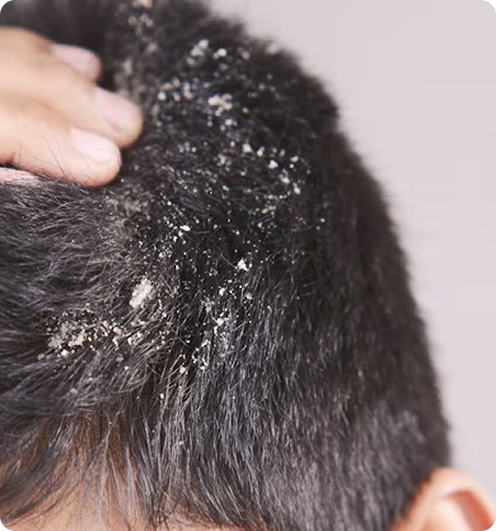 Dandruff